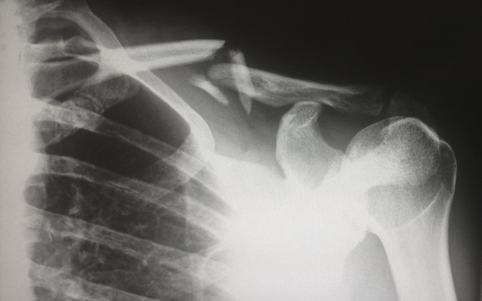 Stress Fractures and HBOT: Why Bones Heal Faster With Pressurized Oxygen